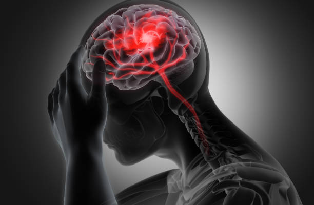 Best migraine doctor in Ranchi